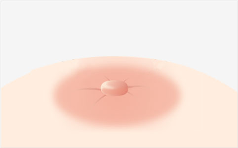 비정상적유두