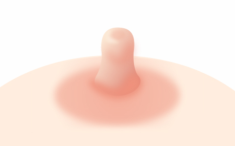 비정상적유두